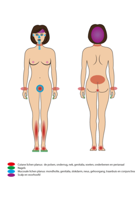 figuur-vrouw-met-plaatsen-waar-lp-voor-kan-komen-2