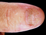 lichenplanus-nail1-protectwyjqcm90zwn0il0-focusfillwzi5ncwymjisingildfd